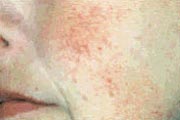 Aura: médico partner - Nd:YAG Laser